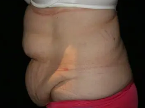 Tummy Tuck 05 Before - 3