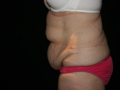Tummy Tuck 05 Before - 2