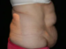 Tummy Tuck 05 Before - 2 - Thumbnail