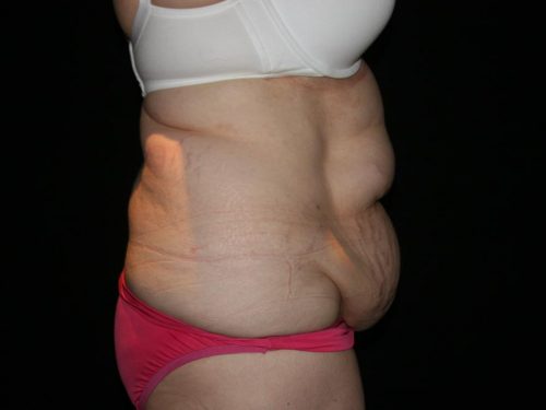 Tummy Tuck 05 Before - 3