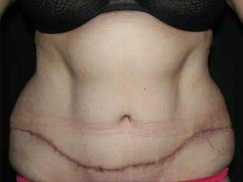 Tummy Tuck 05 After