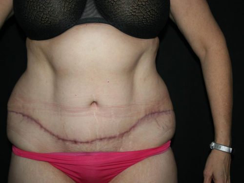 Tummy Tuck 05 After