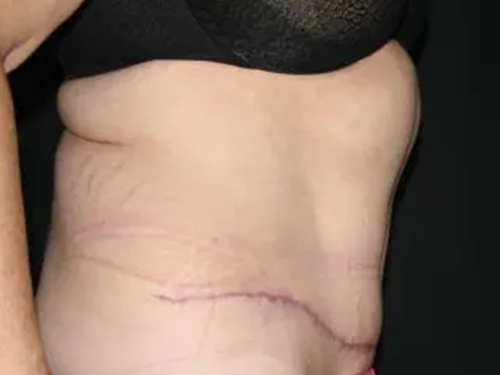 Tummy Tuck 05 After - 2
