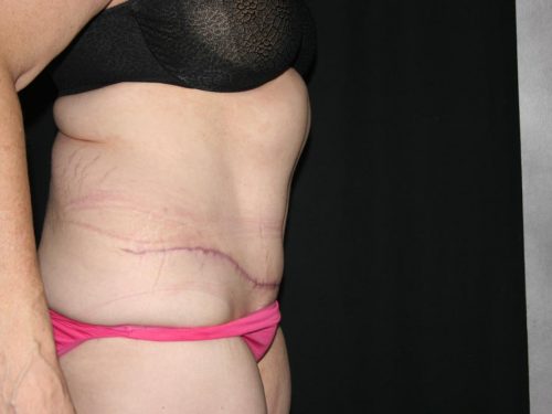 Tummy Tuck 05 After - 3