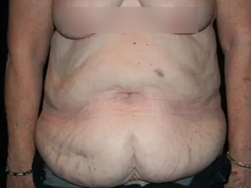 Tummy Tuck 06 Before