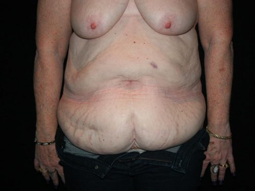 Tummy Tuck 06 Before
