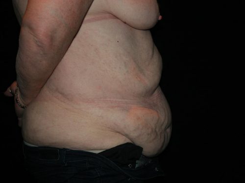Tummy Tuck 06 Before - 2