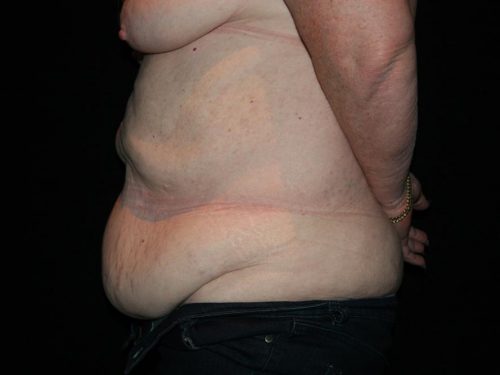Tummy Tuck 06 Before - 3