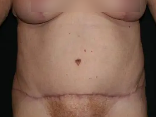 Tummy Tuck 06 After
