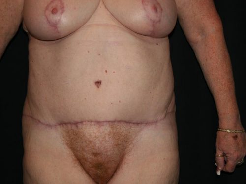 Tummy Tuck 06 After