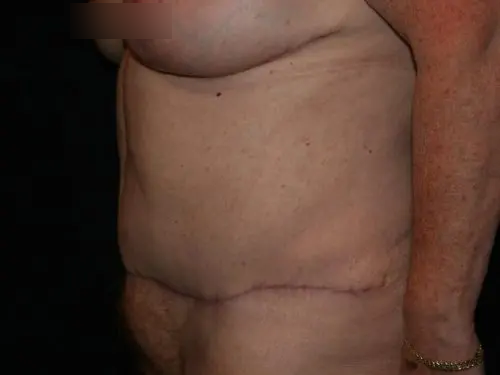 Tummy Tuck 06 After - 2
