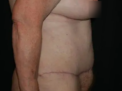 Tummy Tuck 06 After - 3