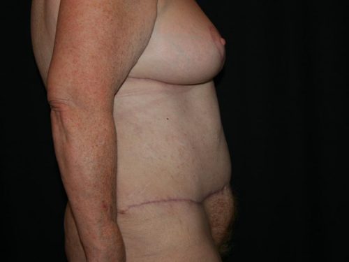 Tummy Tuck 06 After - 2