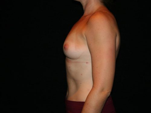 Breast Augmentation 06 Before - 3