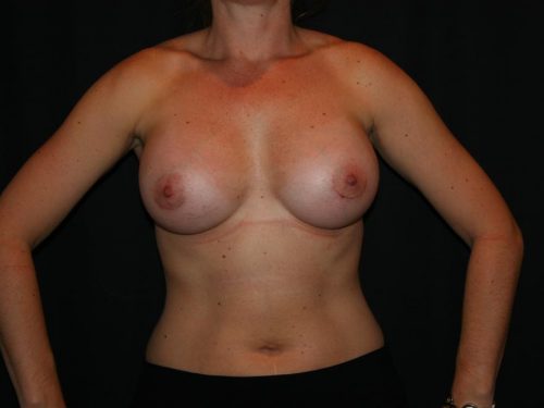 Breast Augmentation 06 After