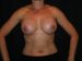 Breast Augmentation 06 After - Thumbnail