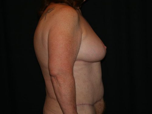 Breast Lift 03 After - 3