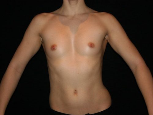 Breast Augmentation 07 Before