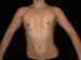 Breast Augmentation 07 Before - Thumbnail