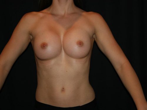 Breast Augmentation 07 After