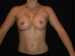 Breast Augmentation 07 After - Thumbnail
