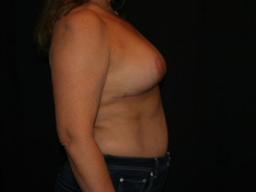 Breast Lift 04 After - 3