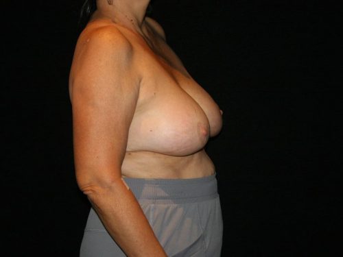 Breast Lift 05 Before - 3