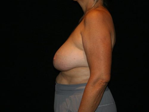 Breast Lift 05 Before - 2