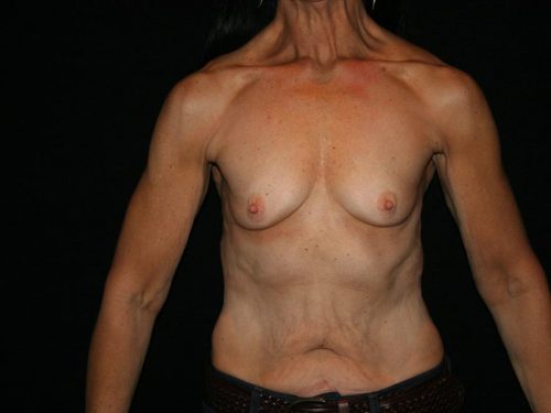 Breast Augmentation 09 Before