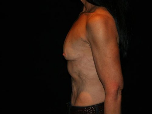 Breast Augmentation 09 Before - 3