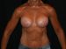 Breast Augmentation 09 After - Thumbnail