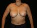 Breast Lift 06 Before - Thumbnail