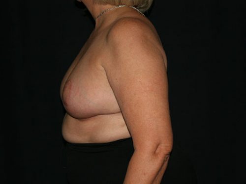 Breast Lift 07 After - 2