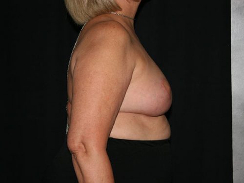 Breast Lift 07 After - 3