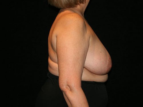 Breast Lift 07 Before - 3