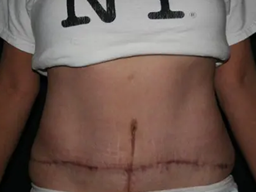 Tummy Tuck 07 After