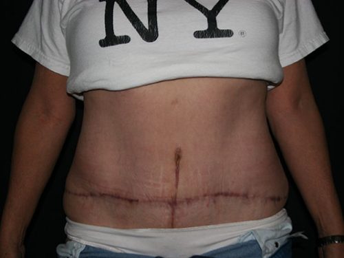 Tummy Tuck 07 After