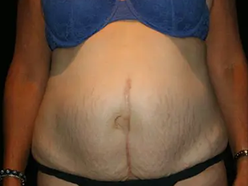 Tummy Tuck 07 Before