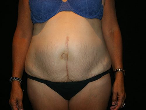 Tummy Tuck 07 Before