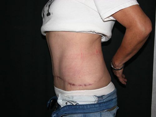 Tummy Tuck 07 After - 2