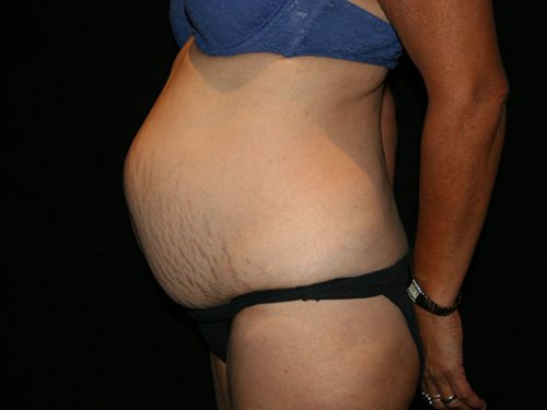 Tummy Tuck 07 Before - 2