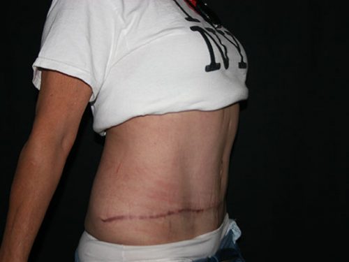 Tummy Tuck 07 After - 3