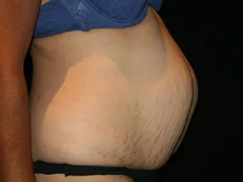 Tummy Tuck 07 Before - 3