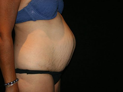 Tummy Tuck 07 Before - 3