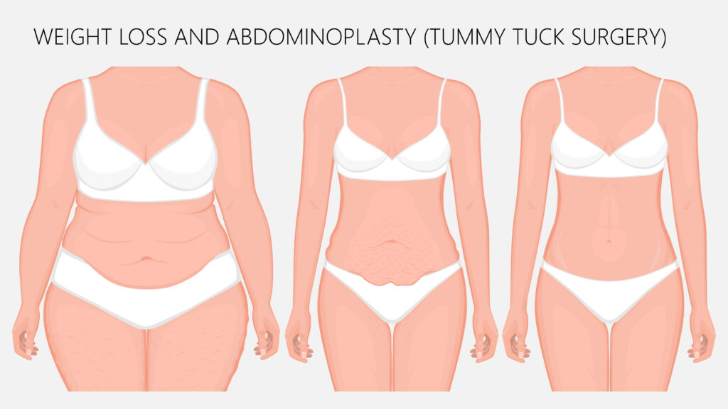 weight loss, abdominoplasty, tummy tuck plastic surgery in woman-img-blog