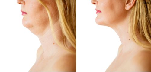 An example of excess skin drooping beneath the chin. This is a common problem in men and women as the effects of aging set it.
