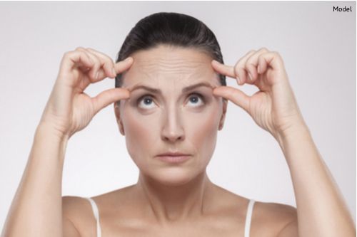 A woman struggles with wrinkling in her forehead despite having healthy laxity throughout the rest of her face. A browlift or full facelift can help address this condition.