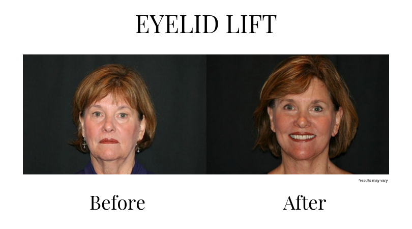 A before an after example of a woman who underwent an eyelid lift. Her face is much livelier and has softer contouring after the procedure.