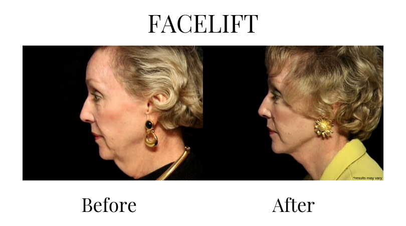 A before and after view of a woman who had a facelift surgery. Severe skin laxity around the jaw and chin was corrected.