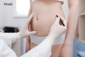 Woman undergoing a liposuction consultation